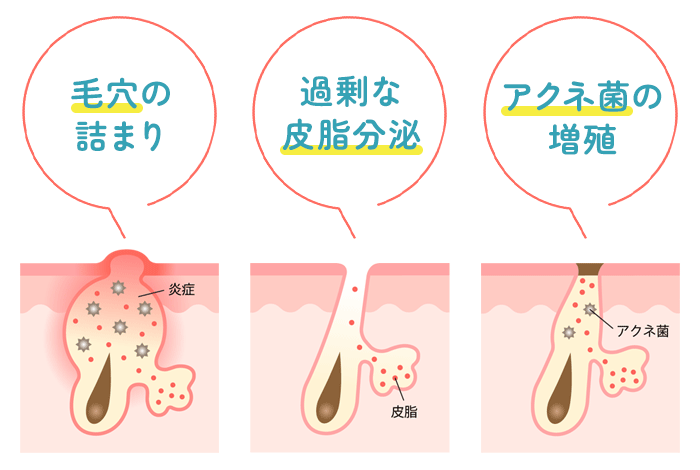 大人ニキビができる原因は毛穴の詰まり・過剰な皮脂分泌・アクネ菌の増殖